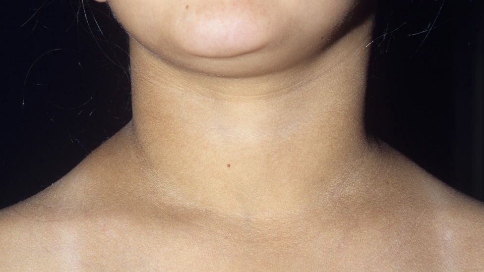 Kako smo se upoznale i zauvek rastale moja štitasta žlezda i ja 3 Goitre (swollen neck) of a 10- year-old girl with hypothyroidism