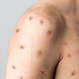 Infektolog: Nema indikacija da će doći do pandemije majmunskih boginja 10