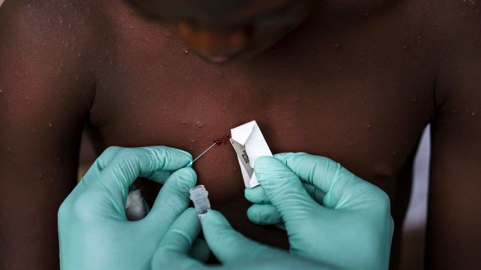 Majmunske boginje i Srbija: Ima li razloga za brigu i ko je zaštićen 4 A teenage boy is suspected of suffering from the MonkeyPox virus in Manfuette, Republic of Congo Tuesday August 29, 2017.