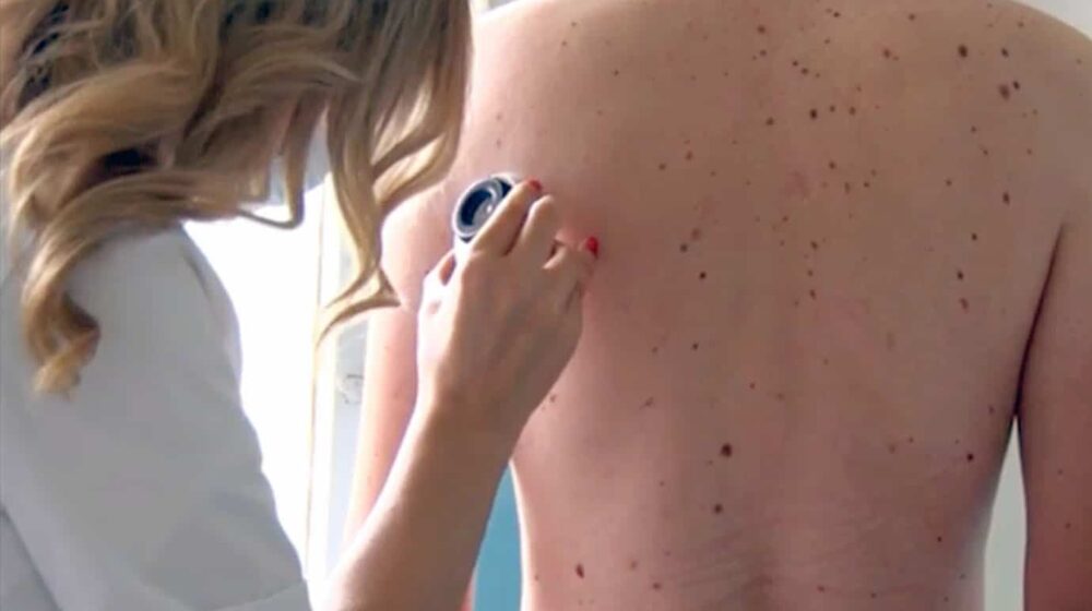 Šta su otkrili nedavni besplatni dermatološki pregledi u užičkim selima Mokra Gora i Karan 1