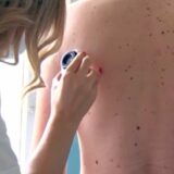 Šta su otkrili nedavni besplatni dermatološki pregledi u užičkim selima Mokra Gora i Karan 1
