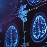Nauka i mentalno zdravlje: Može li veštačka inteligencija da pomogne u lečenju Alchajmerove bolesti 11