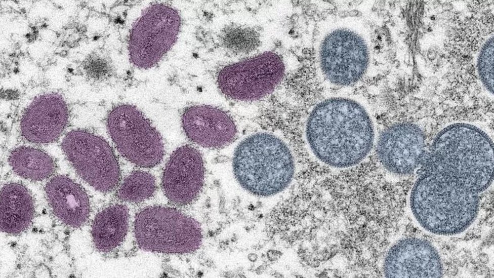 Microscope image of the Monkeypox virus