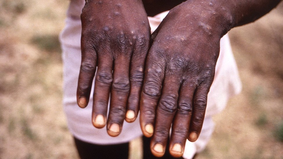 The hands of a patient with a rash due to monkeypox,