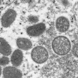 SZO: Potvrđeno više od 5.000 slučajeva majmunskih boginja 6