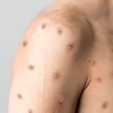 SAD uskoro počinju distribuciju 800.000 doza vakcine protiv majkunskih boginja 6