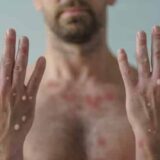 Vanredna situacija zbog majmunskih boginja: SZO izdala najviši stepen upozorenja 8