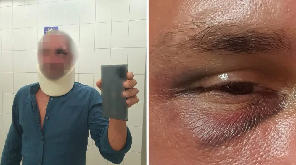 "Dok su me krvnički tukli, govorio sam im da biju pogrešnog čoveka": Beograđanin koji je pretučen na Korčuli o detaljima napada za Danas 1