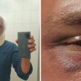 "Dok su me krvnički tukli, govorio sam im da biju pogrešnog čoveka": Beograđanin koji je pretučen na Korčuli o detaljima napada za Danas 13