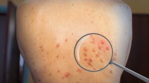 Broj slučajeva majmunskih boginja u Sijera Leoneu od početka godine dostigao je 3.011, uključujući 14 ljudi koji su preminuli nakon što su se zarazili tim virusom, saopštilo je danas tamošnje Ministarstvo zdravlja.