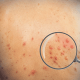 U Indiji zabeležen prvi slučaj majmunskih boginja 5