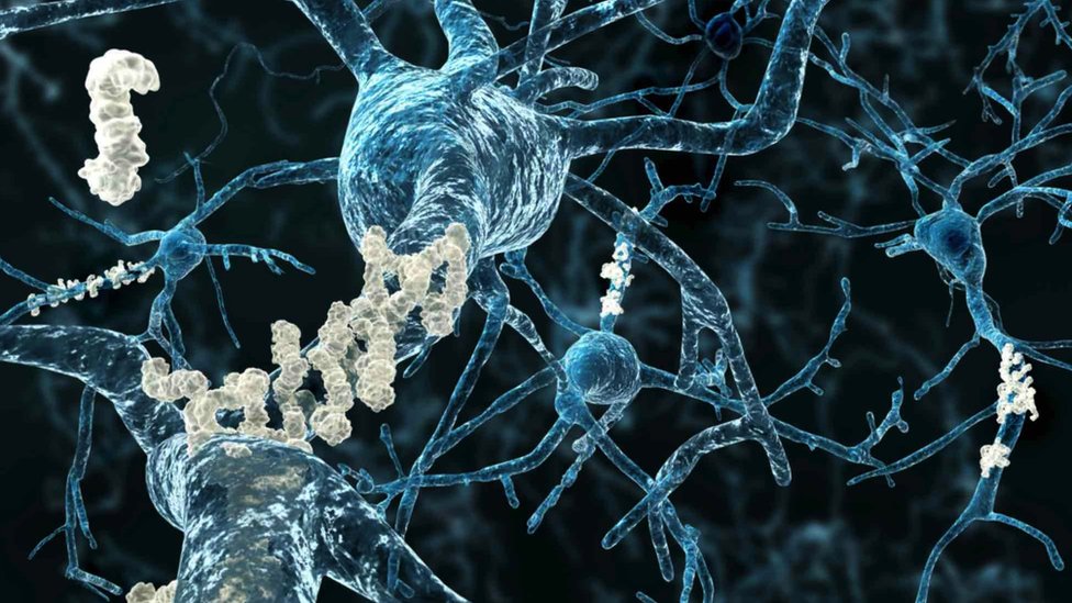 Amyloid plaques shown on axons of neurons affected by Alzheimer's disease