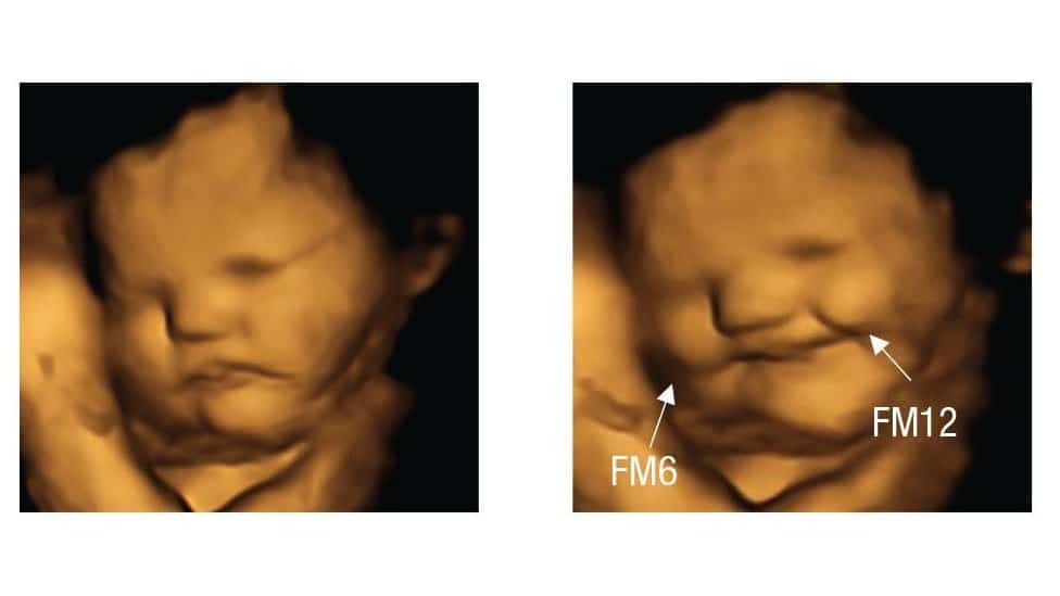 A 4D image of what appears to be a smiling foetus