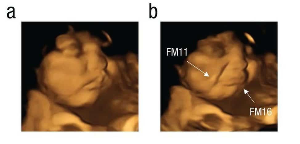 Image from FETAP study of a baby looking relaxed then of its face contorted