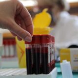 Skoro 40 odsto obolelih od multipli mijeloma čini radno sposobno stanovništvo 8