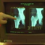 Zdravlje: Šta je osteoporoza i šta utiče na gustinu kostiju 12