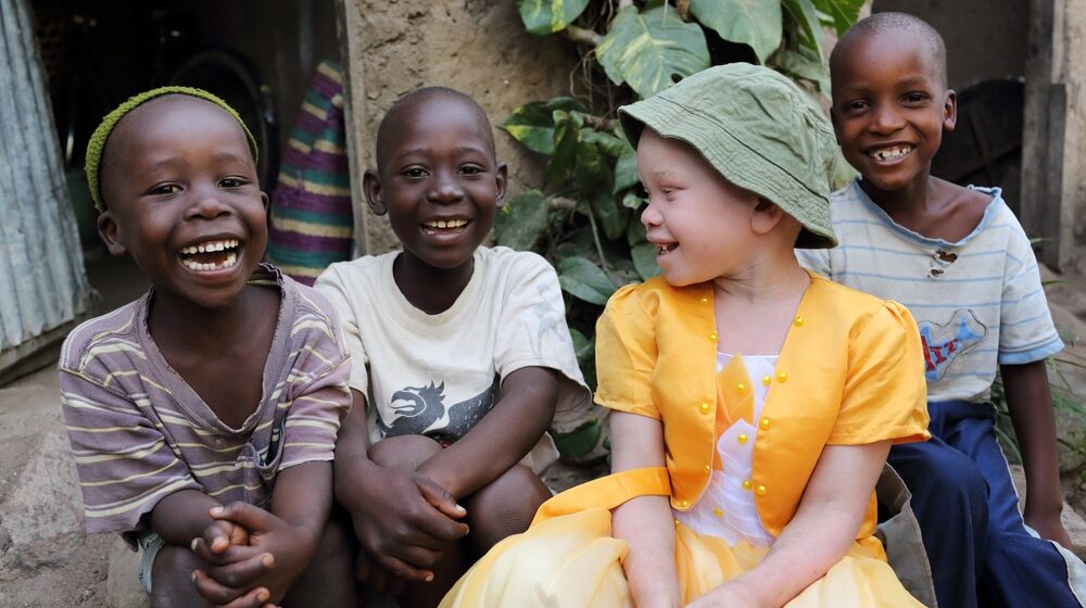 Jeziva sudbina albino crnaca: Bogataši veruju da im njihovi delovi tela mogu doneti novac i moć 1