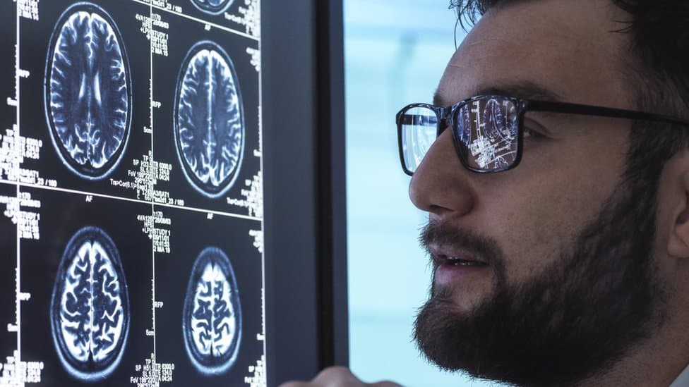 Medicina i nauka: Novi lek protiv Alchajmera značajno otkriće, tvrde lekari 1 Doctor looks at brain scans