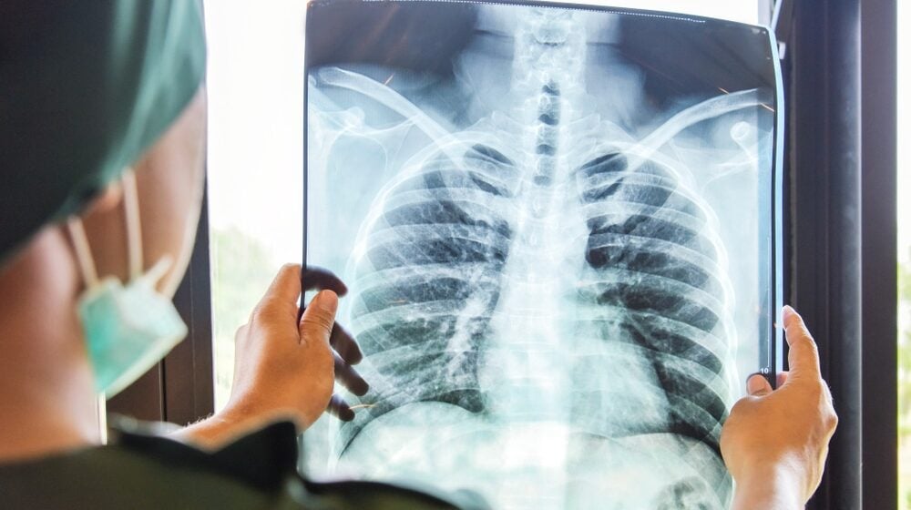 Tuberkuloza je postala najzaraznija bolest u svetu: Pretekla je i kovid i sidu 1