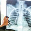 Broj zaraženih tuberkulozom u SAD 2023. najveći u poslednjoj deceniji 40