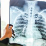 Tuberkuloza je postala najzaraznija bolest u svetu: Pretekla je i kovid i sidu 23