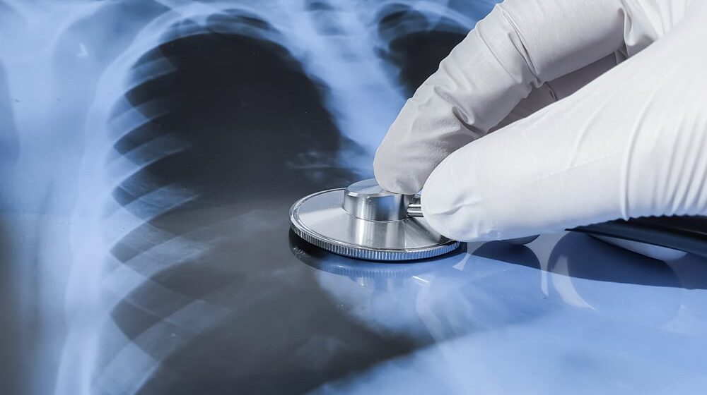 Šta je tuberkuloza i koji su njeni simptomi? 1