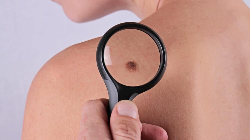 Preventivni pregledi za otkrivanje raka kože 20. maja 13