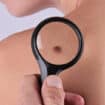 Preventivni pregledi za otkrivanje raka kože 20. maja 12