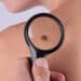 Preventivni pregledi za otkrivanje raka kože 20. maja 4