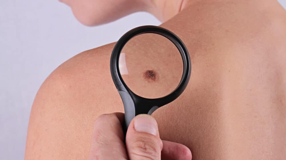 Obeležen Mesec borbe protiv melanoma u Novom Sadu: Ljudi će uvek umirati od ove bolesti, ali mnogi u Srbiji su od nje umrli a da nisu morali 2