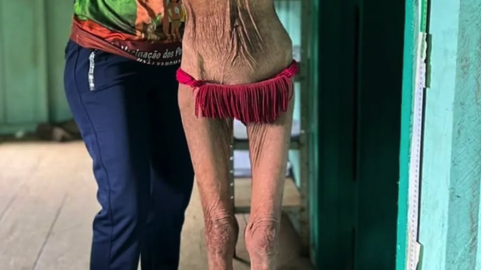 A malnourished Yanomami woman