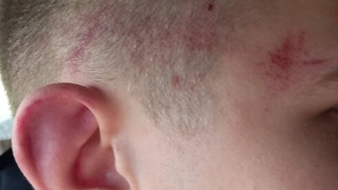 Pretučen dečak Kancelarija za KiM: Srpskog dečaka pretukla četiri starija Albanca u naselju Suvi Do 4