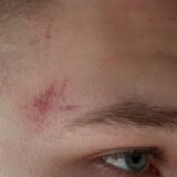 Kancelarija za KiM: Srpskog dečaka pretukla četiri starija Albanca u naselju Suvi Do 2