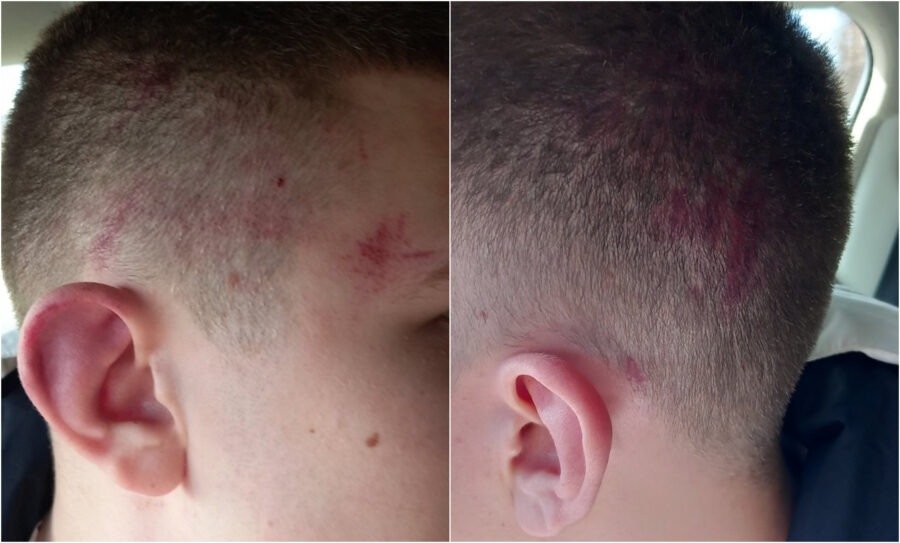 Uhapšena jedna osoba zbog napada na srpskog dečaka u Suvom Dolu 1