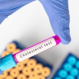 Ovo je simptom visokog holesterola koji mnogi zanemaruju 1