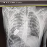 Izvađena neeksplodirana granata iz tela vojnika tokom operacije 6