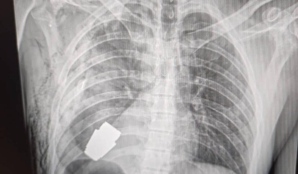 Izvađena neeksplodirana granata iz tela vojnika tokom operacije 1