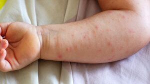 Ministarstvo zdravlja za Danas o hitnim merama za sprečavanje epidemije morbila 1