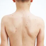 Sve više malih boginja u Evropi zbog manje stope vakcinacije 5