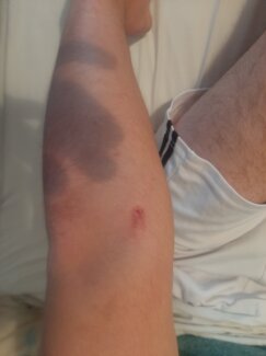 Povređeni Stefan Tomić Još jedan srpski mladić napadnut noćas na KiM dok se vraćao sa bratom s ponoćne Božićne liturgije (FOTO) 3