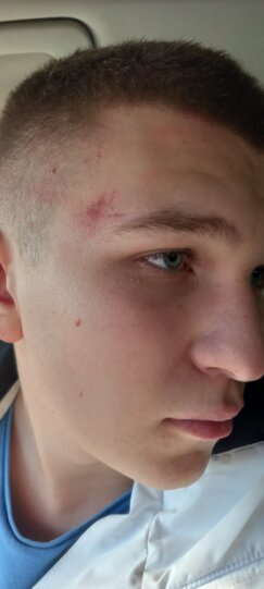 Претучени Лазар М. - 2, фотографија ККиМ Kancelarija za KiM: Srpskog dečaka pretukla četiri starija Albanca u naselju Suvi Do 3