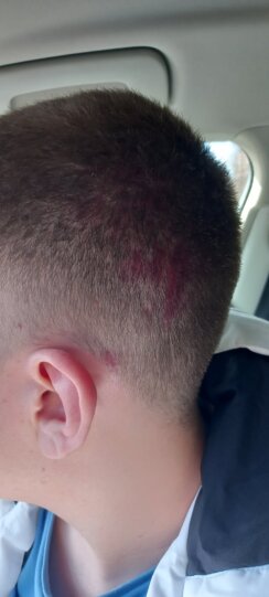 Претучени Лазар М. - 3, фотографија ККиМ Kancelarija za KiM: Srpskog dečaka pretukla četiri starija Albanca u naselju Suvi Do 2