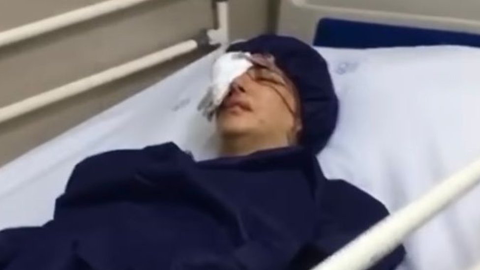 Iran i protesti: Oslepljeni demonstranti traže pomoć preko društvenih mreža 1 Elahe Tavokolian in hospital after being shot in the eye