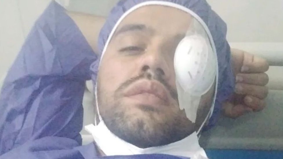 Iran i protesti: Oslepljeni demonstranti traže pomoć preko društvenih mreža 4 Mohammad Farzi in hospital with his injured eye