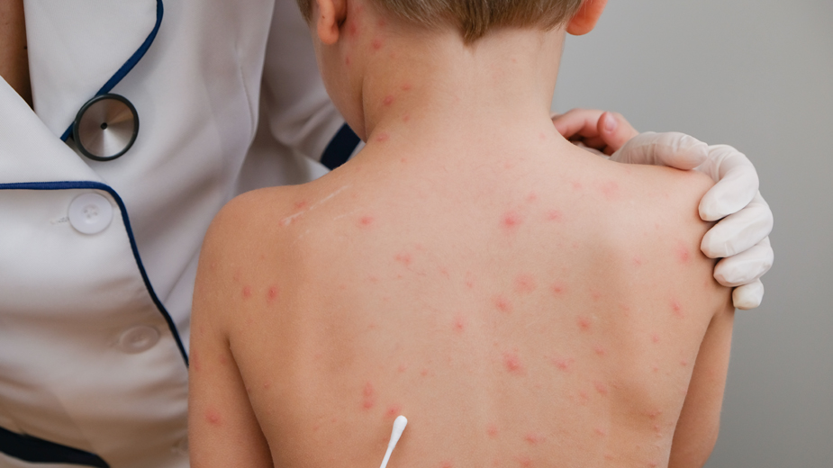 Ni grip, ni kovid: Koja je najčešće registrovana zarazna bolest u Beogradu? 1