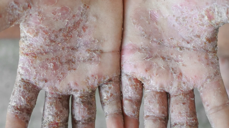 Postoje mesta koje ugarac voli": Dermatolokinja o simptomima uge i  nainu leenja - Zdravlje - Dnevni list Danas