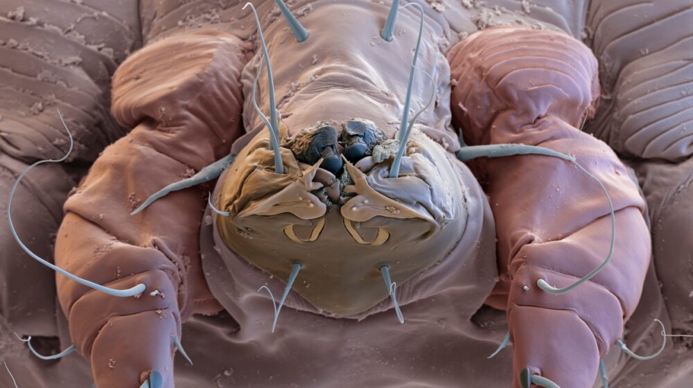 Ovo su simptomi šuge: Preparati sumpora, benzil benzoat i permetrin su terapija 1