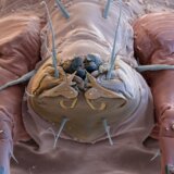 Ovo su simptomi šuge: Preparati sumpora, benzil benzoat i permetrin su terapija 9