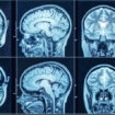 Evo kako visok pritisak oštećuje mozak i izaziva demenciju: Naučno otkriće koje menja tok lečenja 20