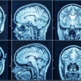 Evo kako visok pritisak oštećuje mozak i izaziva demenciju: Naučno otkriće koje menja tok lečenja 9